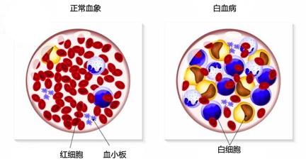 甲醛檢測機構(gòu)告訴你甲醛與白血病之間有著怎樣的聯(lián)系